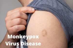 Monkeypox Virus Disease Outbreak