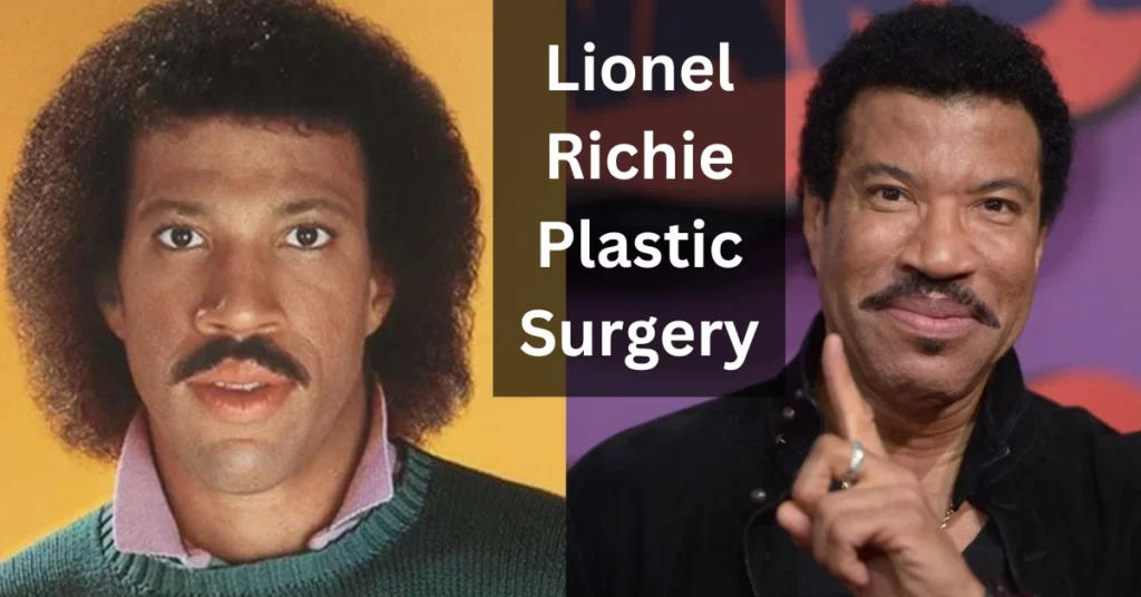 Lionel Richie Plastic Surgery